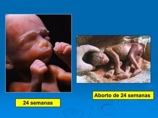 Aborto de 24 semanas
24 semanas
 