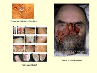 Epidermolizis Bülloza Simpleks




                                  Bazal Hücreli Karsinom

             Psöriyazis (Sedef)
 