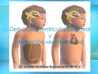 DR. DANIEL MARTÍNEZ BUSTAMANTEDR. DANIEL MARTÍNEZ BUSTAMANTE
NEUROCIRUJANONEUROCIRUJANO
Derivación ventriculoperitoneal
y
derivación ventriculoatrial
 