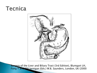 Surgery of the Liver and Biliary Tract (3rd Edition), Blumgart LH,
Fong Y and WH Jarnigan (Eds.) W.B. Saunders, London, UK (2000
 