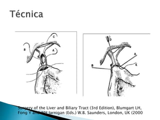 Surgery of the Liver and Biliary Tract (3rd Edition), Blumgart LH,
Fong Y and WH Jarnigan (Eds.) W.B. Saunders, London, UK (2000
 