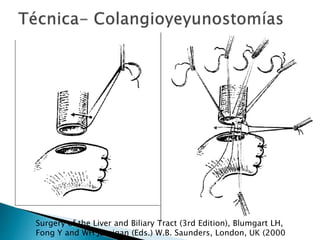 Surgery of the Liver and Biliary Tract (3rd Edition), Blumgart LH,
Fong Y and WH Jarnigan (Eds.) W.B. Saunders, London, UK (2000
 