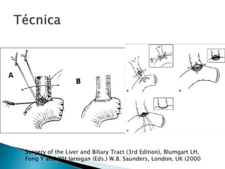 Surgery of the Liver and Biliary Tract (3rd Edition), Blumgart LH,
Fong Y and WH Jarnigan (Eds.) W.B. Saunders, London, UK (2000
 