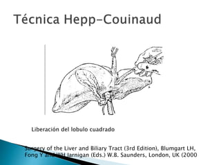 Surgery of the Liver and Biliary Tract (3rd Edition), Blumgart LH,
Fong Y and WH Jarnigan (Eds.) W.B. Saunders, London, UK (2000
Liberación del lobulo cuadrado
 