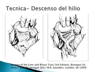 Surgery of the Liver and Biliary Tract (3rd Edition), Blumgart LH,
Fong Y and WH Jarnigan (Eds.) W.B. Saunders, London, UK (2000
 
