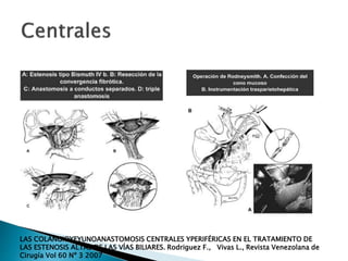 LAS COLANGIOYEYUNOANASTOMOSIS CENTRALES YPERIFÉRICAS EN EL TRATAMIENTO DE
LAS ESTENOSIS ALTAS DE LAS VÍAS BILIARES. Rodriguez F., Vivas L., Revista Venezolana de
Cirugía Vol 60 Nº 3 2007
 