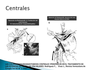 LAS COLANGIOYEYUNOANASTOMOSIS CENTRALES YPERIFÉRICAS EN EL TRATAMIENTO DE
LAS ESTENOSIS ALTAS DE LAS VÍAS BILIARES. Rodriguez F., Vivas L., Revista Venezolana de
Cirugía Vol 60 Nº 3 2007
 