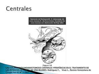 LAS COLANGIOYEYUNOANASTOMOSIS CENTRALES YPERIFÉRICAS EN EL TRATAMIENTO DE
LAS ESTENOSIS ALTAS DE LAS VÍAS BILIARES. Rodriguez F., Vivas L., Revista Venezolana de
Cirugía Vol 60 Nº 3 2007
 