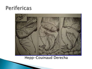 Hepp-Couinaud Derecha
 
