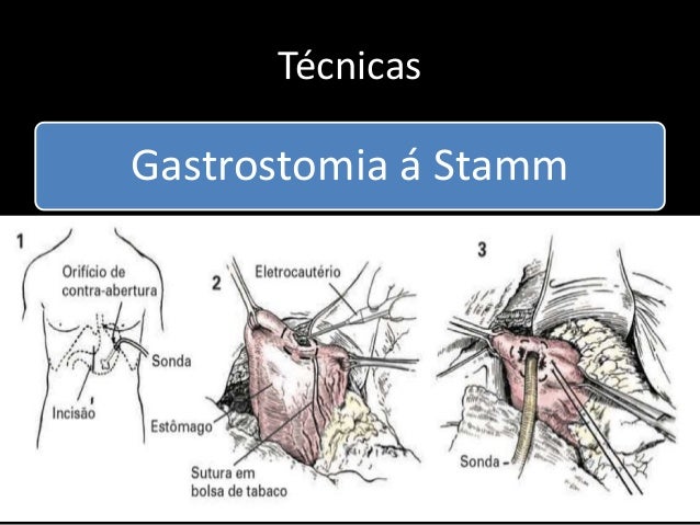 Derivações intestinais sem video