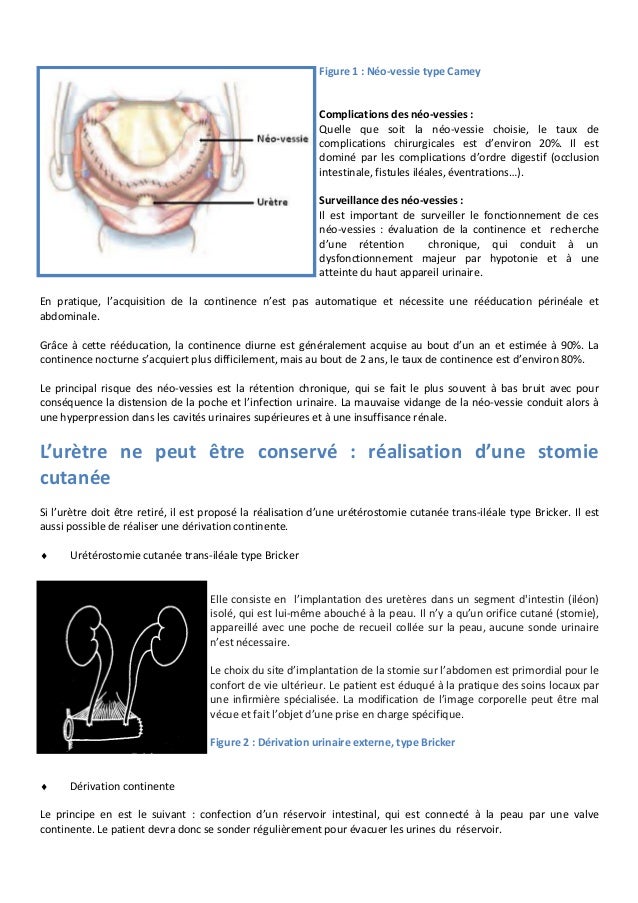 Derivation Urinaire 1