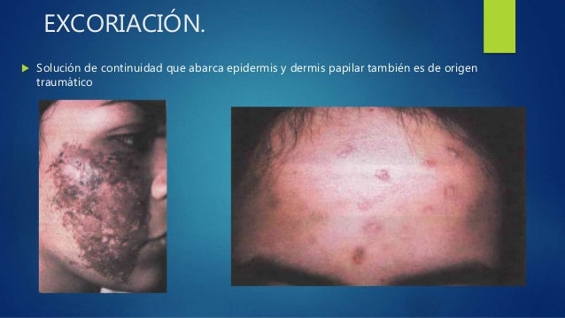 Dermatologia Lesiones elementales