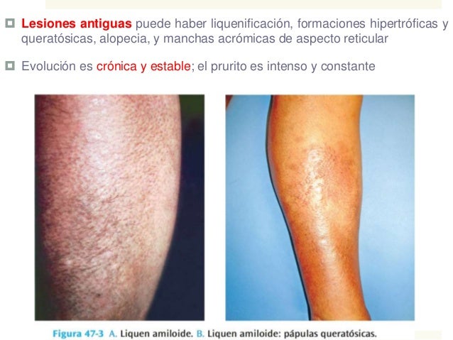 Qué son dieta cetogénica cancer ?