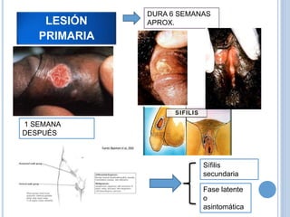 LESIÓN
PRIMARIA
1 SEMANA
DESPUÉS
DURA 6 SEMANAS
APROX.
Sífilis
secundaria
Fase latente
o
asintomática
 