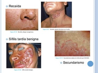  Recaída
 Sífilis tardía benigna
 Secundarismo
 