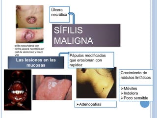 sífilis secundaria con
forma úlcera necrótica en
piel de abdomen y brazo
VIH
SÍFILIS
MALIGNA
Las lesiones en las
mucosas
Adenopatías
Crecimiento de
nódulos linfáticos
Móviles
Indolora
Poco sensible
Úlcera
necrótica
Pápulas modificadas
que erosionan con
rapidez
 