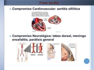  Compromiso Cardiovascular: aortitis sifílitica
 Compromiso Neurológico: tabes dorsal, meningo
encefalitis, parálisis general
Fase tardia
 
