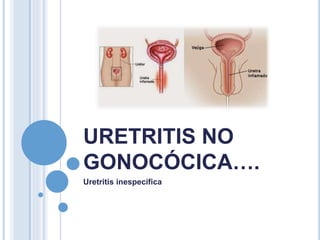 URETRITIS NO
GONOCÓCICA….
Uretritis inespecífica
 