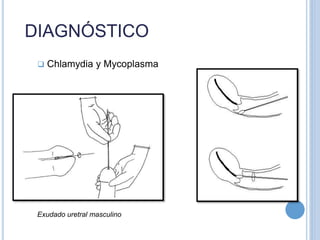  Chlamydia y Mycoplasma
DIAGNÓSTICO
Exudado uretral masculino
 