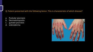 Q. Patient presented with the following lesion. This is characteristic of which disease?
a. Pustular psoriasis
b. Dermatomyositis
c. guttate psoriasis
d. scleroderma
 