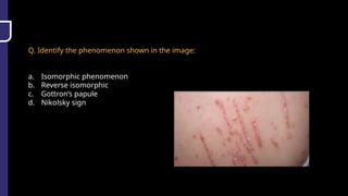 Q. Identify the phenomenon shown in the image:
a. Isomorphic phenomenon
b. Reverse isomorphic
c. Gottron’s papule
d. Nikolsky sign
 