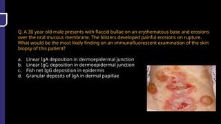 Q. A 30 year old male presents with flaccid bullae on an erythematous base and erosions
over the oral mucous membrane. The blisters developed painful erosions on rupture.
What would be the most likely finding on an immunofluorescent examination of the skin
biopsy of this patient?
a. Linear IgA deposition in dermoepidermal junction
b. Linear IgG deposition in dermoepidermal junction
c. Fish net IgG deposition in epidermis
d. Granular deposits of IgA in dermal papillae
 