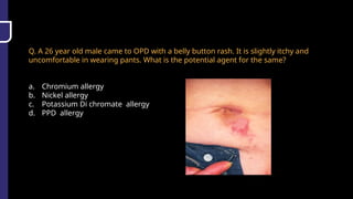 Q. A 26 year old male came to OPD with a belly button rash. It is slightly itchy and
uncomfortable in wearing pants. What is the potential agent for the same?
a. Chromium allergy
b. Nickel allergy
c. Potassium Di chromate allergy
d. PPD allergy
 