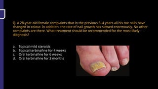 Q. A 28-year-old female complaints that in the previous 3–4 years all his toe nails have
changed in colour. In addition, the rate of nail growth has slowed enormously. No other
complaints are there. What treatment should be recommended for the most likely
diagnosis?
a. Topical mild steroids
b. Topical terbinafine for 4 weeks
c. Oral terbinafine for 6 weeks
d. Oral terbinafine for 3 months
 