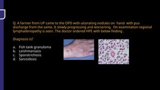Q. A farmer from UP came to the OPD with ulcerating nodules on hand with pus
discharge from the same. It slowly progressing and worsening. On examination regional
lymphadenopathy is seen. The doctor ordered HPE with below finding .
Diagnosis is?
a. Fish tank granuloma
b. Leishmaniasis
c. Sporotrichosis
d. Sarcoidosis
 
