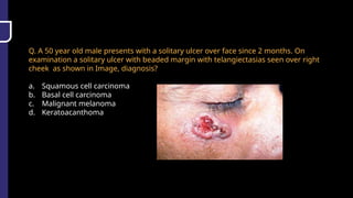 Q. A 50 year old male presents with a solitary ulcer over face since 2 months. On
examination a solitary ulcer with beaded margin with telangiectasias seen over right
cheek as shown in Image, diagnosis?
a. Squamous cell carcinoma
b. Basal cell carcinoma
c. Malignant melanoma
d. Keratoacanthoma
 