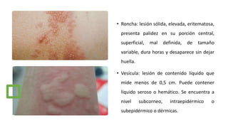 • Roncha: lesión sólida, elevada, eritematosa,
presenta palidez en su porción central,
superficial, mal definida, de tamaño
variable, dura horas y desaparece sin dejar
huella.
• Vesícula: lesión de contenido líquido que
mide menos de 0,5 cm. Puede contener
líquido seroso o hemático. Se encuentra a
nivel subcorneo, intraepidérmico o
subepidérmico o dérmicas.
 