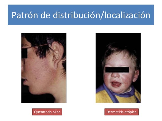 El jardín de infancia y la psoriasis al niño