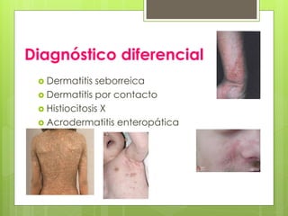 Diagnóstico diferencial
 Dermatitis seborreica
 Dermatitis por contacto
 Histiocitosis X
 Acrodermatitis enteropática
 ictiosis
 