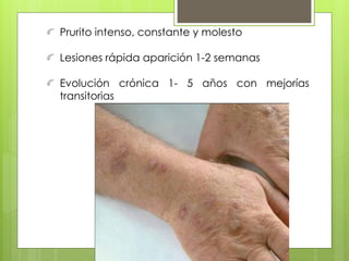 Prurito intenso, constante y molesto
Lesiones rápida aparición 1-2 semanas
Evolución crónica 1- 5 años con mejorías
transitorias
 