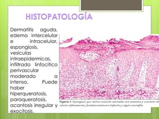 HISTOPATOLOGÍA
Dermatitis aguda,
edema intercelular
e intracelular,
espongiosis,
vesículas
intraepidermicas,
infiltrado linfocitico
perivascular
moderado a
intenso. Puede
haber
hiperqueratosis,
paraqueratosis,
acantosis irregular y
exocitosis.
 