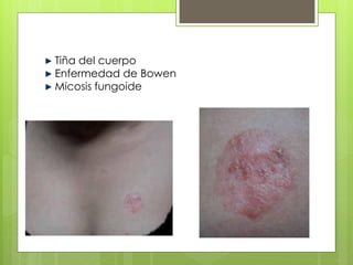 Tiña del cuerpo
Enfermedad de Bowen
Micosis fungoide
 