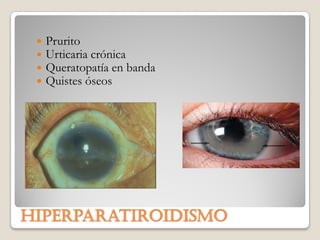   Prurito
    Urticaria crónica
    Queratopatía en banda
    Quistes óseos




Hiperparatiroidismo
 