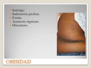    Intértigo
    Sudoración profusa
    Estrías
    Acantosis nigricans
    Hirsutismo




obesidad
 