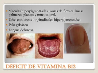  Máculas hiperpigmentadas: zonas de flexura, líneas
  palmares, plantas y mucosa oral.
 Uñas con líneas longitudinales hiperpigmentadas
 Pelo grisáceo
 Lengua dolorosa




Déficit de VITAMINA b12
 