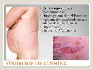  Estrías rojo vinosas
            (patognomónico)
           Hiperpigmentación Ectópico
           Pigmentación parcheada en cara
            interna de labios y encías
           Hipertricosis,
            hirsutismoCarcinoma




SÍNDROME DE CUSHING
 