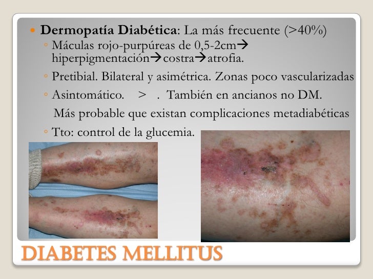 Dermatología en endocrino Dermatología en endocrino