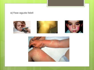 a) Fase aguda febril
 