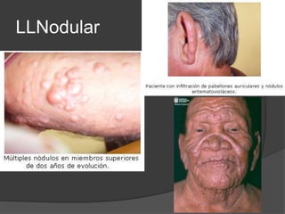 LLNodular
 