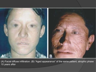(A) Facial diffuse infiltration. (B) “Aged appearance” of the same patient, atrophic phase
10 years after
 