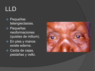 LLD
 Pequeñas
telangiectasias.
 Pequeñas
neoformaciones
(quistes de milium).
 En pies y manos
existe edema.
 Caída de cejas,
pestañas y vello.
 