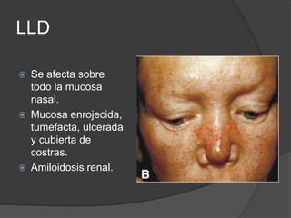 LLD
 Se afecta sobre
todo la mucosa
nasal.
 Mucosa enrojecida,
tumefacta, ulcerada
y cubierta de
costras.
 Amiloidosis renal.
 
