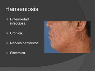 Hanseniosis
 Enfermedad
infecciosa.
 Crónica.
 Nervios periféricos.
 Sistémica.
 