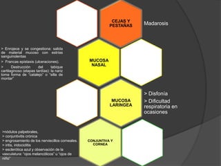 CEJAS Y
PESTAÑAS Madarosis
MUCOSA
NASAL
> Enrojece y se congestiona: salida
de material mucoso con estrías
sanguinolentas
> Francas epistaxis (ulceraciones).
> Destrucción del tabique
cartilaginoso (etapas tardías): la nariz
toma forma de “catalejo” o “silla de
montar”
MUCOSA
LARINGEA
> Disfonía
> Dificultad
respiratoria en
ocasiones
CONJUNTIVA Y
CORNEA
>nódulos palpebrales,
> conjuntivitis crónica
> engrosamiento de los nerviecillos corneales.
> iritis, iridociclitis
> esclerótica azul y observación de la
vasculatura: “ojos melancólicos” u “ojos de
niño”
 