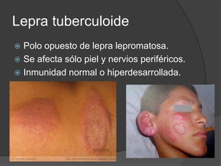 Lepra tuberculoide
 Polo opuesto de lepra lepromatosa.
 Se afecta sólo piel y nervios periféricos.
 Inmunidad normal o hiperdesarrollada.
 
