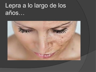 Lepra a lo largo de los
años…
 